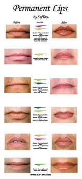 before-and-after-lip-poster
